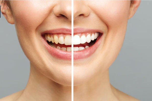 مزایا و معایب کامپوزیت دندان
