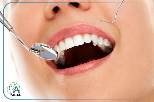 ونیر کامپوزیت دندان چیست