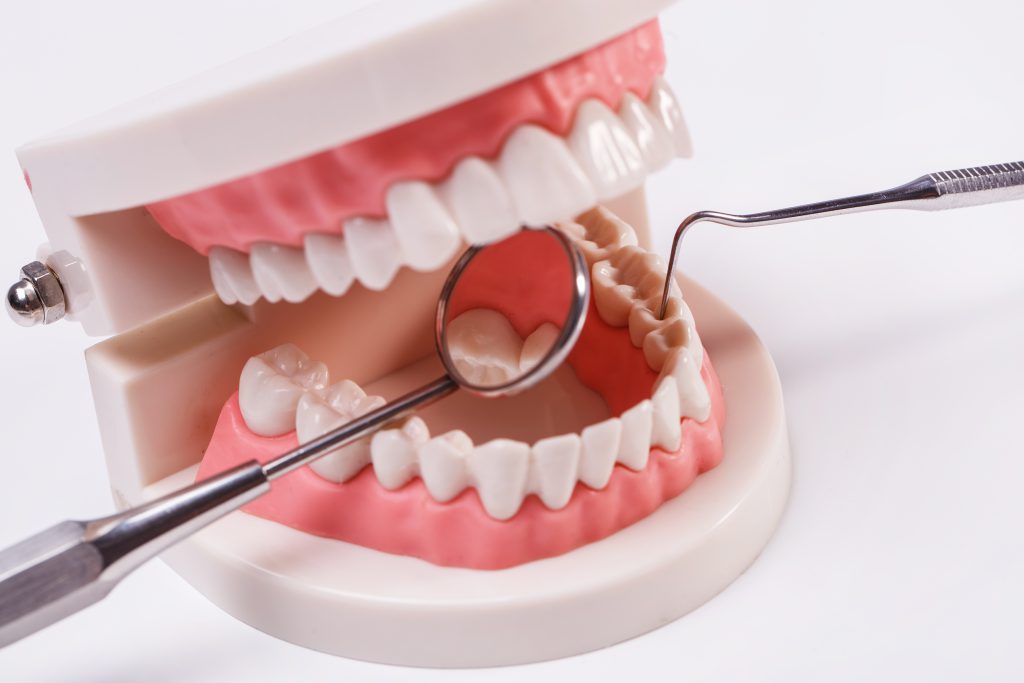روش بریج دندان