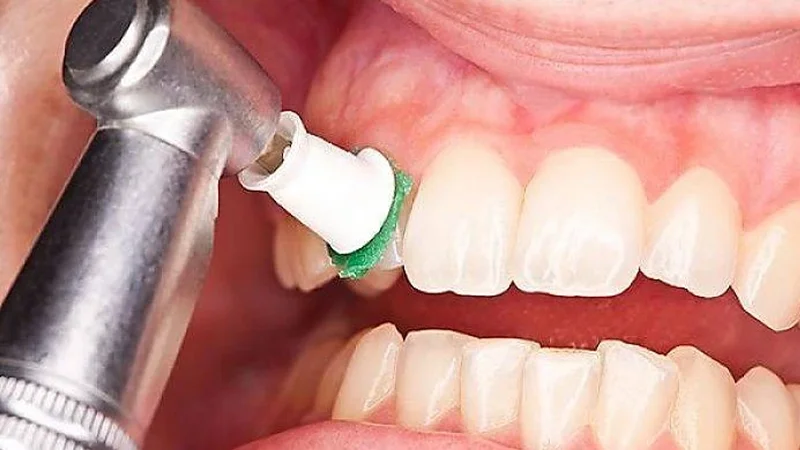 مراحل بروساژ دندان